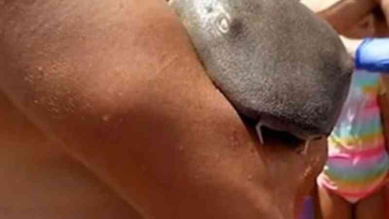 Tubarão que ficou com dentes cravados em antebraço de banhista sobreviveu