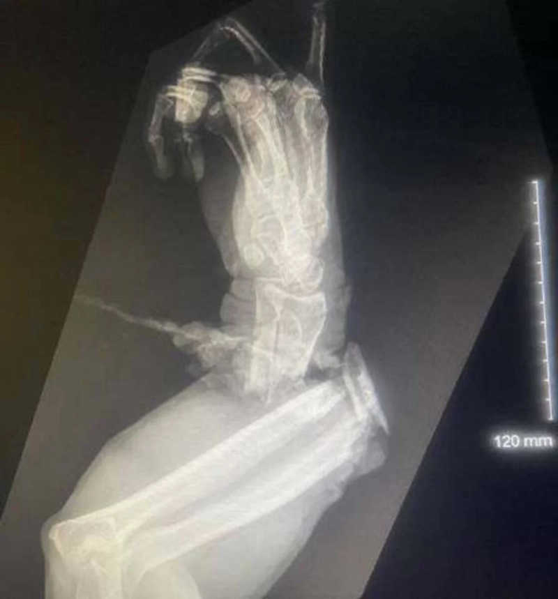 Raio-x do antebraço esquerdo de Greg após o ataque (crédito: Reprodução/Facebook/Florida Gator Gardens)